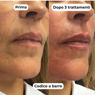 DermaGlow + | Sistema di Microinfusione