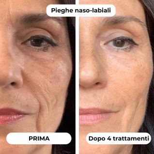 DermaGlow + | Sistema di Microinfusione