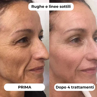 DermaGlow + | Sistema di Microinfusione