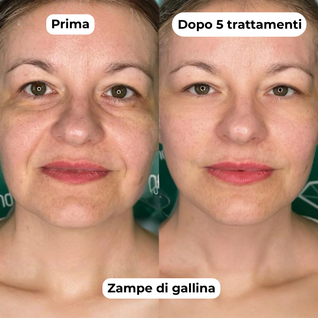 DermaGlow + | Sistema di Microinfusione