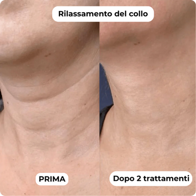 DermaGlow + | Sistema di Microinfusione