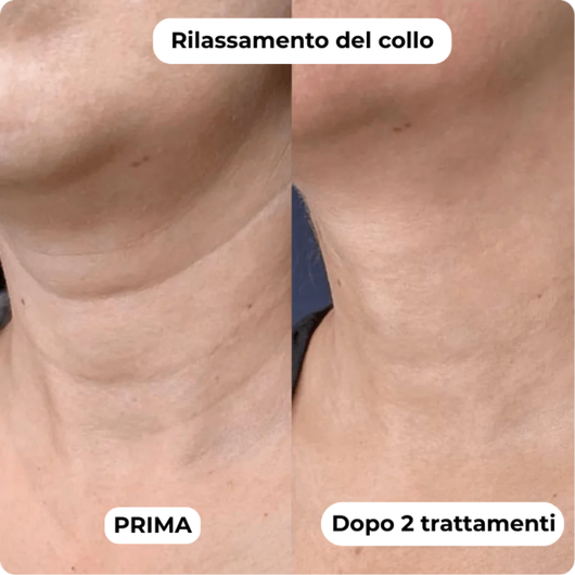 DermaGlow + | Sistema di Microinfusione