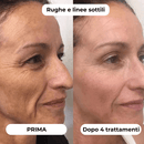 DermaGlow + | Sistema di Microinfusione - ONDIVO