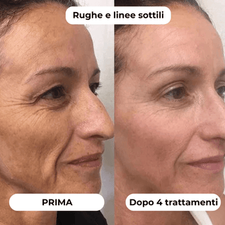 DermaGlow + | Sistema di Microinfusione