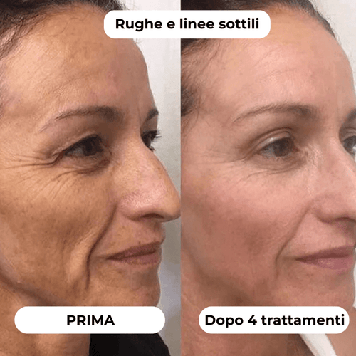 DermaGlow + | Sistema di Microinfusione