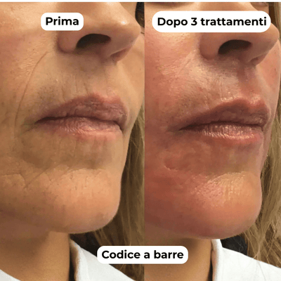 DermaGlow + | Sistema di Microinfusione - ONDIVO