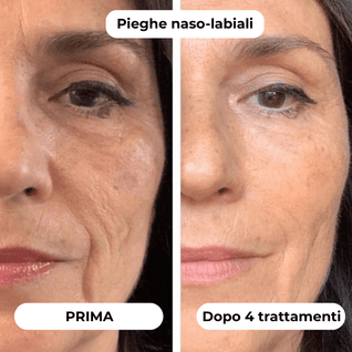 DermaGlow + | Sistema di Microinfusione