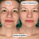 DermaGlow + | Sistema di Microinfusione - ONDIVO