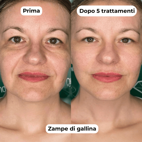 DermaGlow + | Sistema di Microinfusione