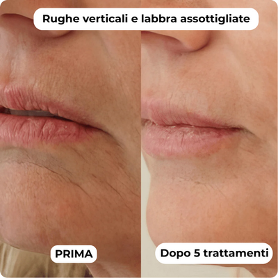 DermaGlow + | Sistema di Microinfusione
