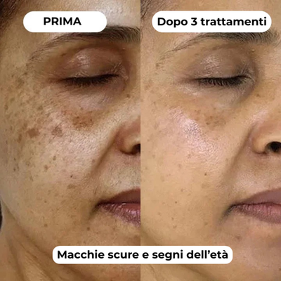 DermaGlow + | Sistema di Microinfusione