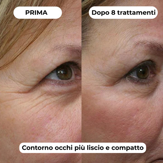 DermaGlow + | Sistema di Microinfusione