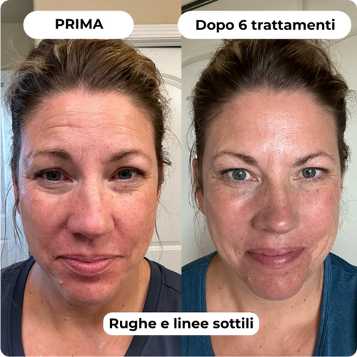 DermaGlow + | Sistema di Microinfusione